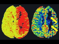 Acute Stroke: Critical Diagnostic Findings